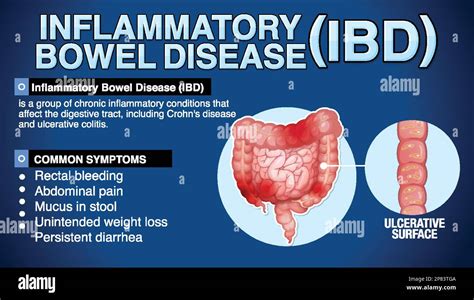 ibdb|inflammatory bowel disease database.